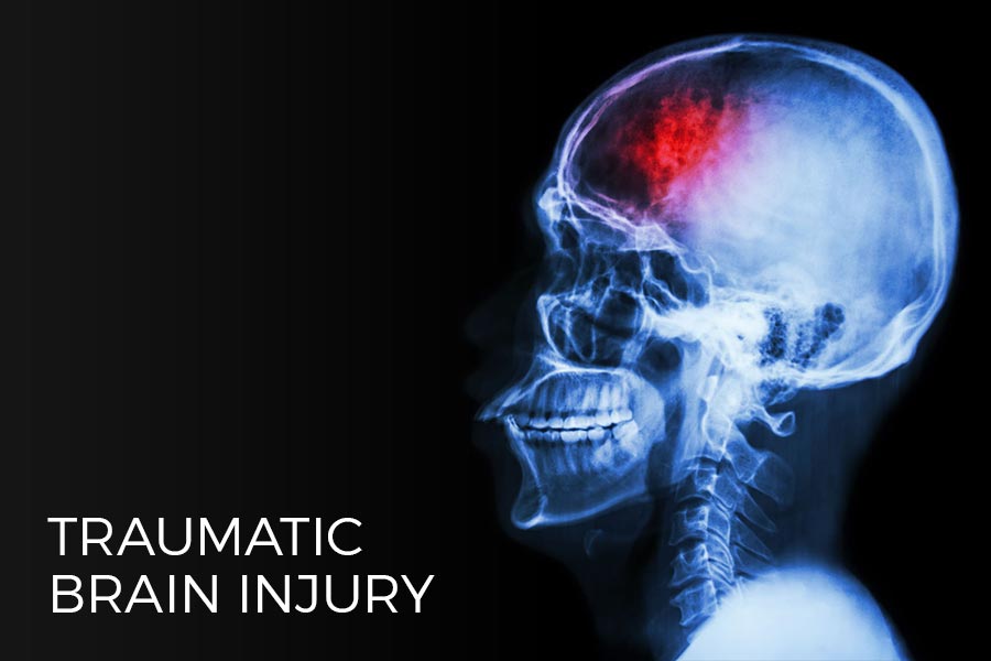 Experienced Temecula Traumatic Brain Injury Lawyer